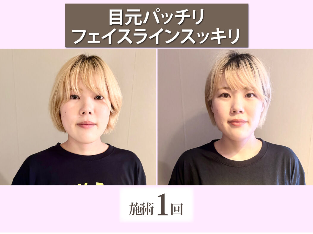 すっきりした小顔になりたい！